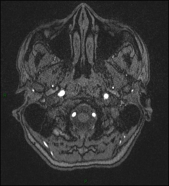 File:Cerebral fat embolism (Radiopaedia 35022-36525 Axial TOF 6).jpg