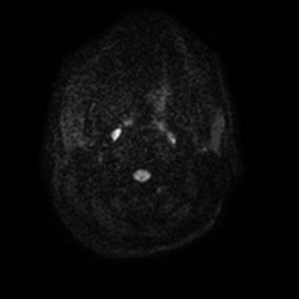 File:Cerebral fat embolism (Radiopaedia 37510-39363 Axial DWI 2).jpg