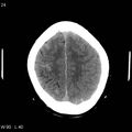 Cerebral hemorrhagic contusion with subdural and subarachnoid hemorrhage (Radiopaedia 10680-19197 Axial non-contrast 20).jpg