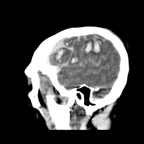File:Cerebral hemorrhagic contusions (Radiopaedia 23145-23188 C 36).jpg