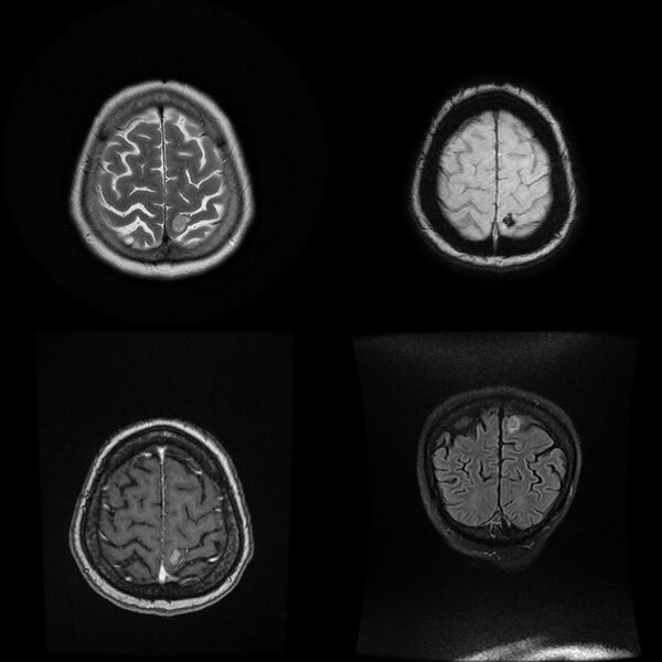 File:Cerebral metastases - melanoma (Radiopaedia 80972-94525 A 1).jpg