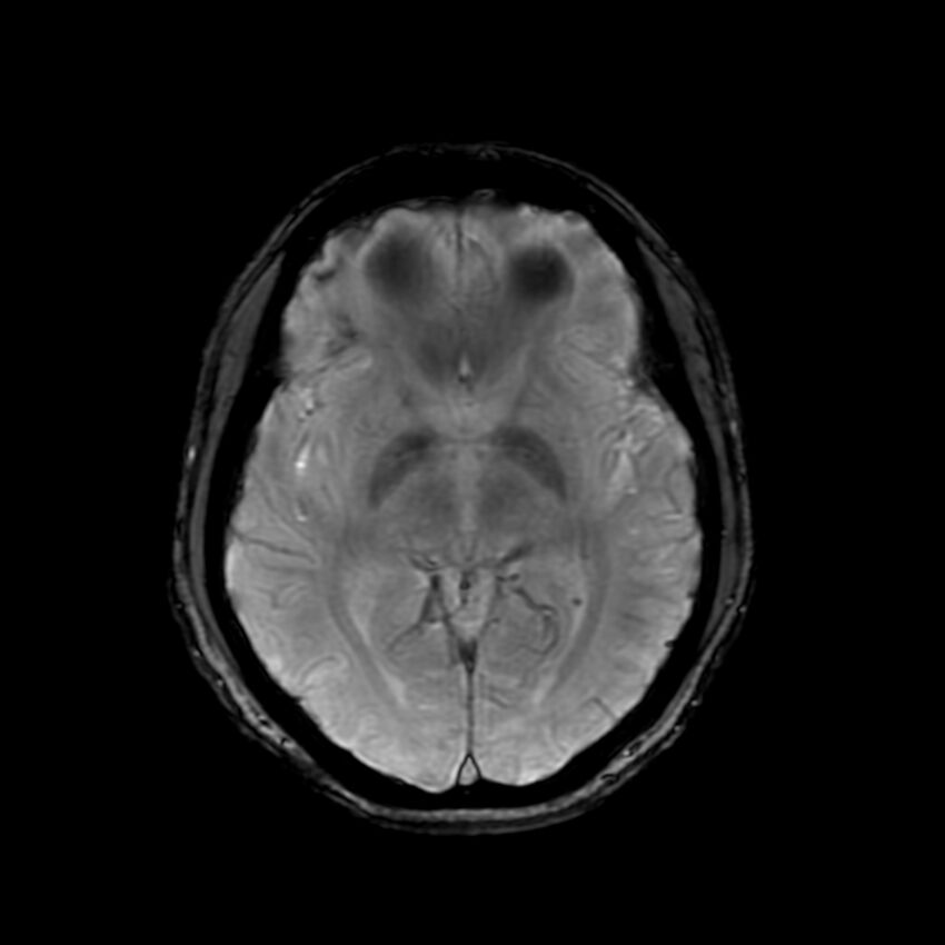 Cerebral paragonimiasis (Radiopaedia 73473-84238 Axial SWI 33).jpg