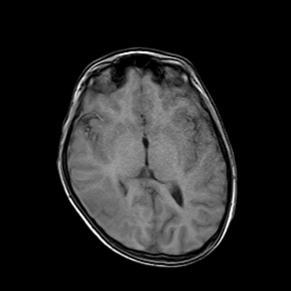 File:Cerebral tuberculoma (Radiopaedia 41152-43932 Axial T1 11).jpg
