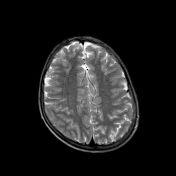 File:Cerebral tuberculoma (Radiopaedia 41152-43932 Axial T2 17).jpg