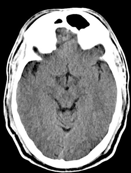File:Cerebral venous angioma (Radiopaedia 69959-79977 Axial non-contrast 14).jpg