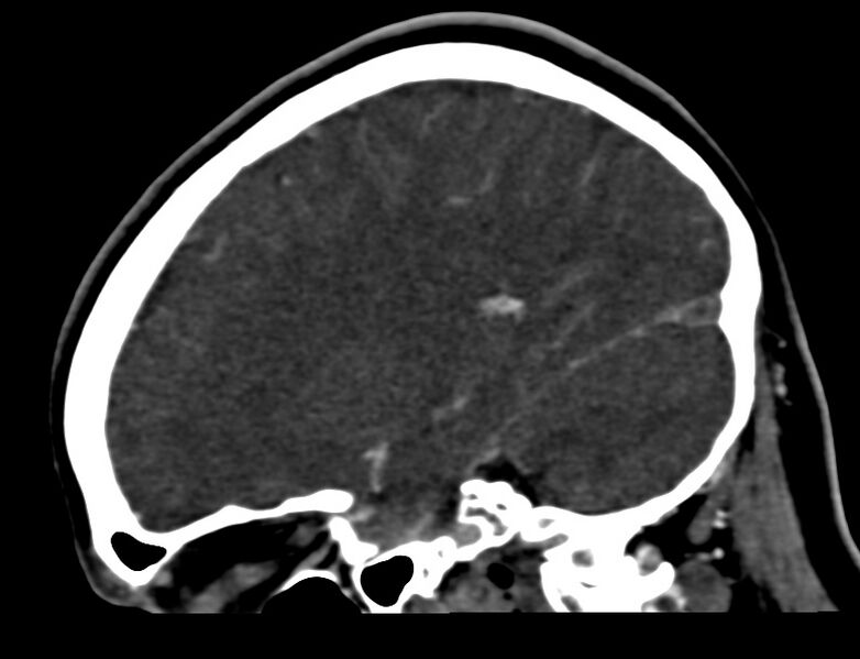 File:Cerebral venous sinus thrombosis (Radiopaedia 59224-66646 Sagittal C+ delayed 40).jpg