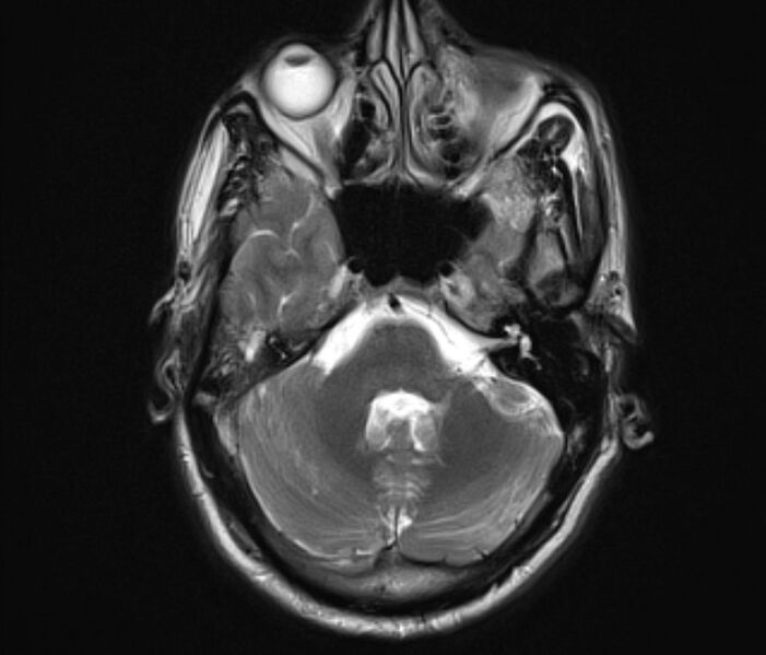 File:Cerebral venous thrombosis (Radiopaedia 71207-81504 Axial T2 8).jpg