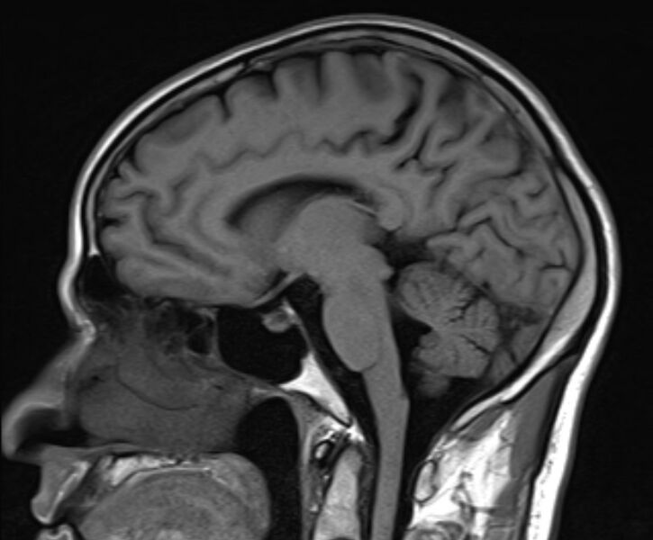File:Cerebral venous thrombosis (Radiopaedia 71207-81504 Sagittal T1 12).jpg