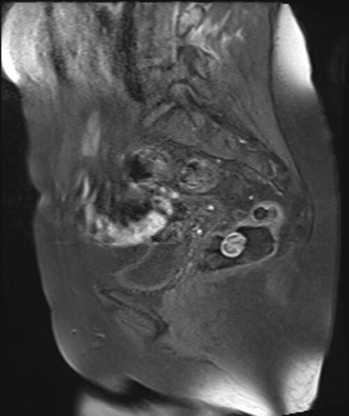 File:Cervical carcinoma (Radiopaedia 88312-104943 Sagittal T1 fat sat 13).jpg