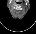 Cervical dural CSF leak on MRI and CT treated by blood patch (Radiopaedia 49748-54996 B 24).png