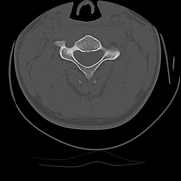 File:Cervical flexion teardrop fracture with cord hemorrhage (Radiopaedia 32497-33454 Axial bone window 35).jpg