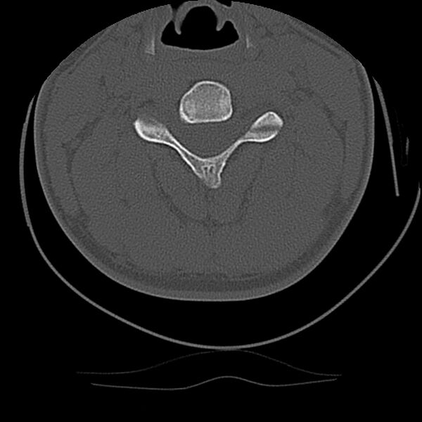 File:Cervical flexion teardrop fracture with cord hemorrhage (Radiopaedia 32497-33454 Axial bone window 37).jpg