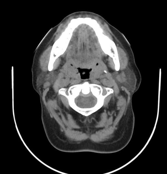 File:Cervical lymphadenopathy- cause unknown (Radiopaedia 22420-22457 non-contrast 31).jpg