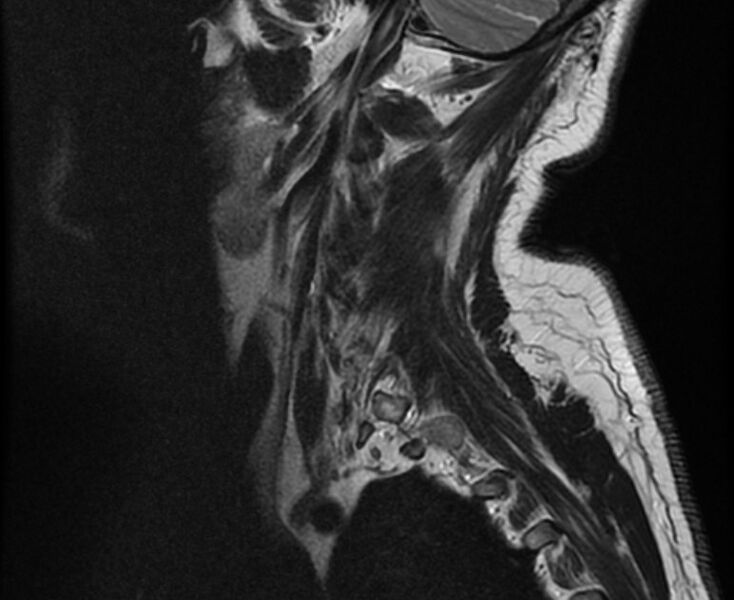 File:Cervical schwannoma (Radiopaedia 72399-82934 Sagittal T2 1).jpg