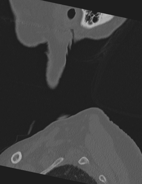 File:Cervical spine ACDF loosening (Radiopaedia 48998-54071 Sagittal bone window 3).png