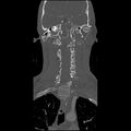 Cervical spine fractures with vertebral artery dissection (Radiopaedia 32135-33078 Coronal bone window 14).jpg