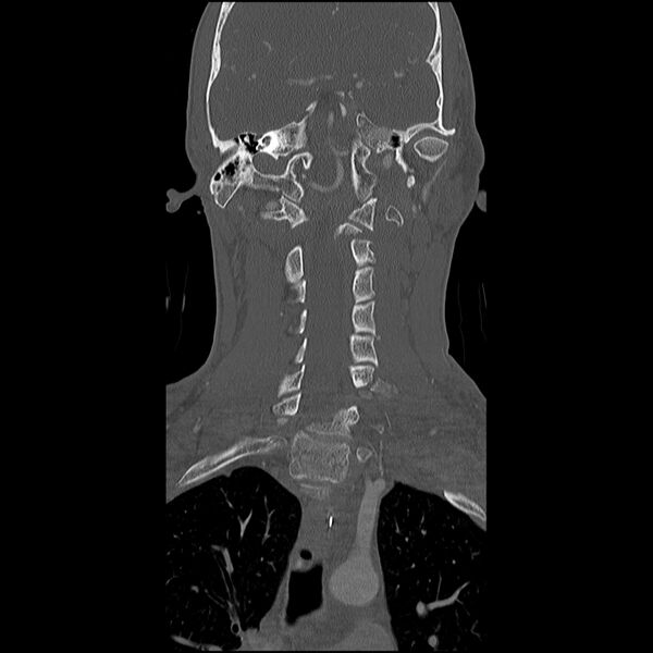 File:Cervical spine fractures with vertebral artery dissection (Radiopaedia 32135-33078 Coronal bone window 14).jpg