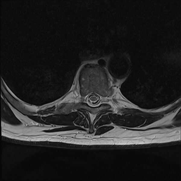 File:Cervical tumor-like myelopathy due to Type V dAVF (Radiopaedia 82461-96604 D 31).jpg