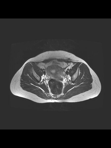 File:Cesarean section scar endometrioma (Radiopaedia 56569-63297 Axial T2 13).jpg