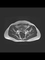 Cesarean section scar endometrioma (Radiopaedia 56569-63297 Axial T2 13).jpg