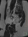 Cesarian scar endometriosis (Radiopaedia 68495-78066 Sagittal T2 5).jpg
