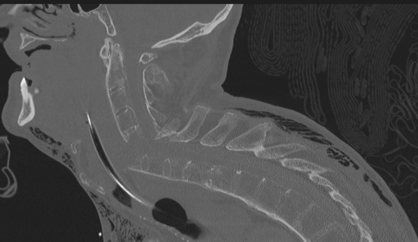 Chalk stick fracture (Radiopaedia 57948-64928 Sagittal bone window 31).png