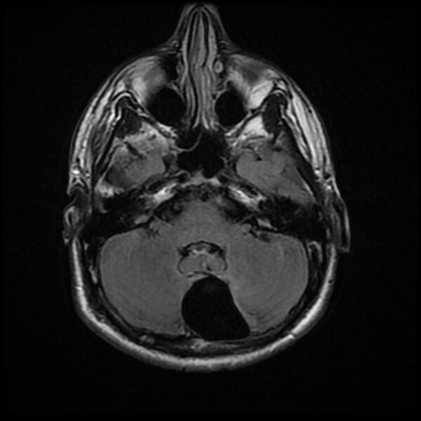File:Chiasmatic-hypothalamic juvenile pilocytic astrocytoma (Radiopaedia 78533-91235 Axial FLAIR 8).jpg