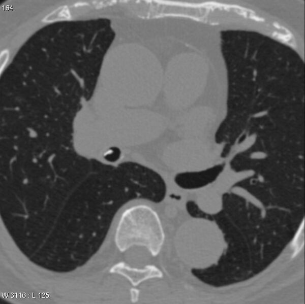 File:Chicken bone in bronchus (Radiopaedia 6550-7861 Axial lung window 1).jpg