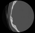 Cholesteatoma (Radiopaedia 20296-20217 bone window 43).jpg