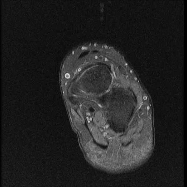 File:Chondroblastoma - midfoot (Radiopaedia 64831-73765 E 7).jpg