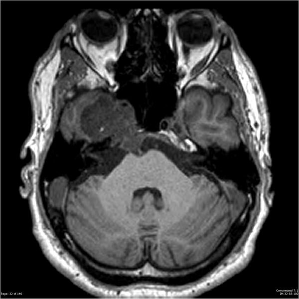 File:Chondrosarcoma of skull base- grade II (Radiopaedia 40948-43654 Axial T1 32).jpg