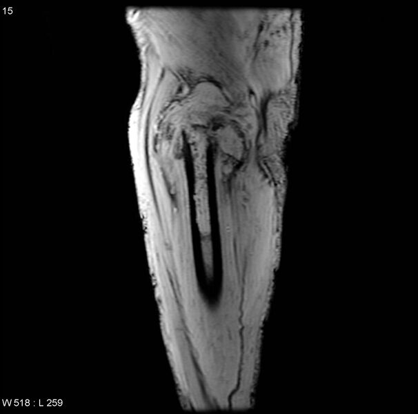 File:Chondrosarcoma with pathological fracture - femur (Radiopaedia 6174-7629 B 1).jpg