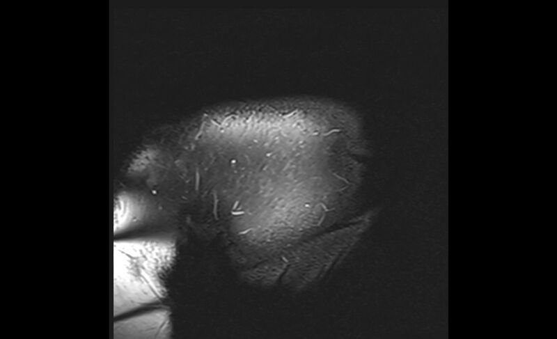 File:Choriocarcinoma in the shoulder (Radiopaedia 28603-28861 Coronal PD FS 34).jpg