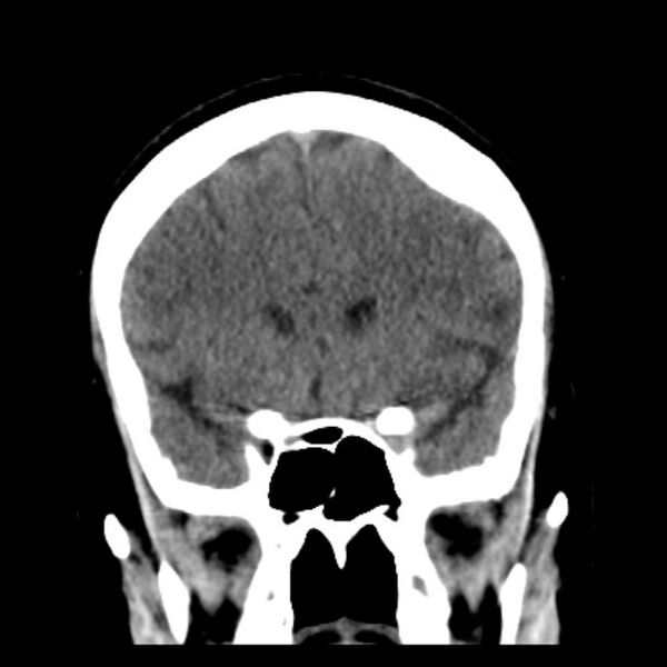 File:Chronic bilateral occipital lobe infarcts (Radiopaedia 31276-31996 Coronal non-contrast 18).jpg