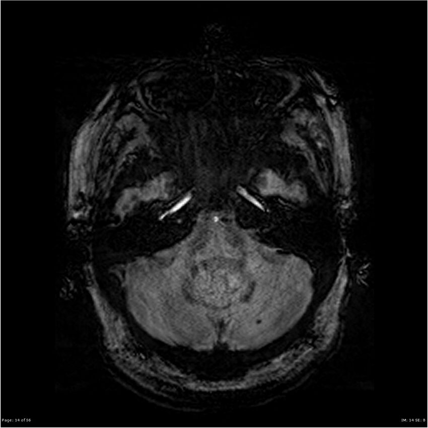 Chronic hypertensive encephalopathy (Radiopaedia 25764-25918 Axial SWI 14).jpg