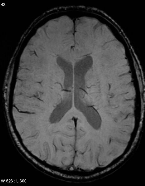 File:Chronic lymphocytic inflammation with pontine perivascular enhancement responsive to steroids (CLIPPERS) (Radiopaedia 37520-39374 Axial SWI 42).jpg