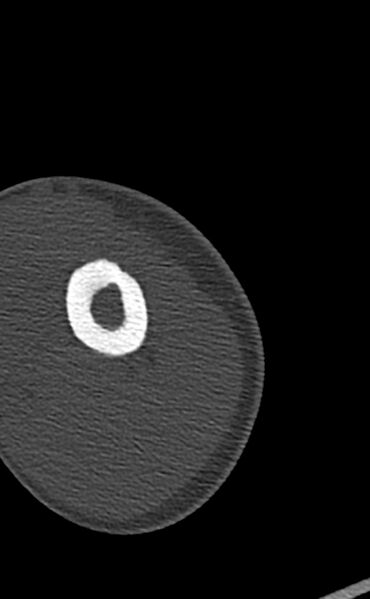File:Chronic osteomyelitis of the distal humerus (Radiopaedia 78351-90971 Axial 101).jpg