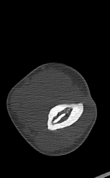 File:Chronic osteomyelitis of the distal humerus (Radiopaedia 78351-90971 Axial bone window 70).jpg
