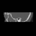 Chronic otomastoiditis (Radiopaedia 27138-27309 Sagittal bone window 8).jpg
