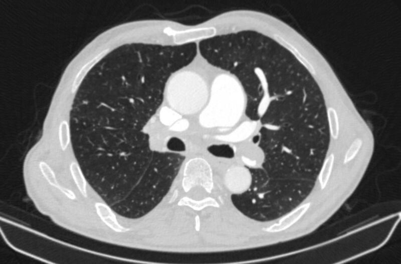 File:Chronic pulmonary embolism (Radiopaedia 91241-108843 Axial lung window 41).jpg