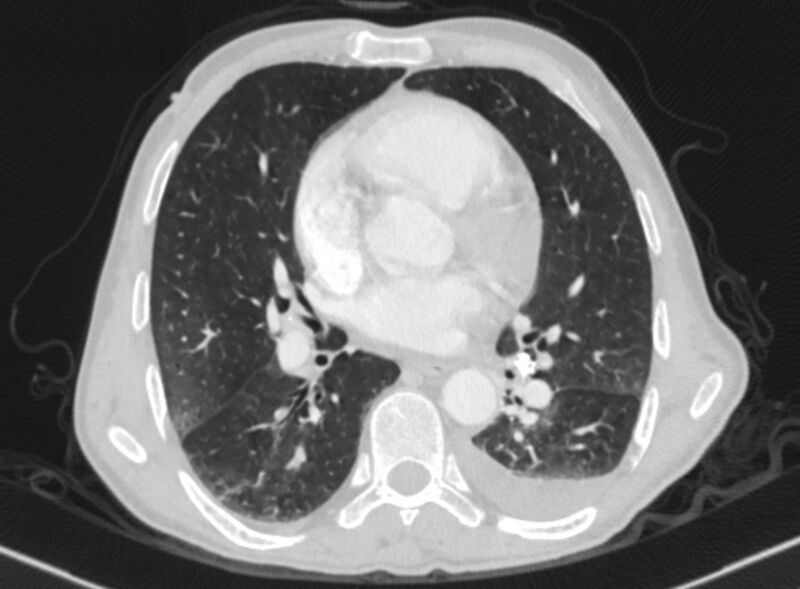 File:Chronic pulmonary embolism with bubbly consolidation (Radiopaedia 91248-108850 Axial lung window 90).jpg