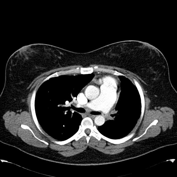 File:Chronic thromboembolic pulmonary hypertension (CTEPH) (Radiopaedia 74597-85531 Axial C+ CTPA 21).jpg