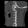 Clay-shoveler fracture (Radiopaedia 22568-22590 Sagittal bone window 35).jpg
