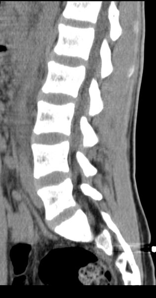 File:Clear cell meningoma - lumbar spine (Radiopaedia 60116-67691 A 19).png