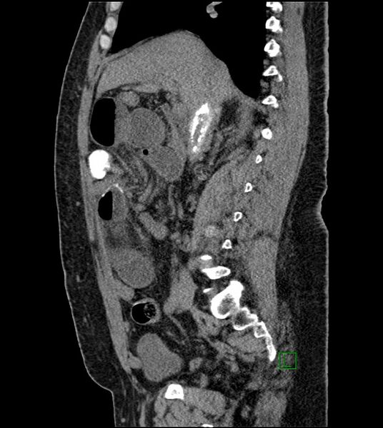 File:Closed-loop small bowel obstruction-internal hernia (Radiopaedia 78439-91096 C 87).jpg