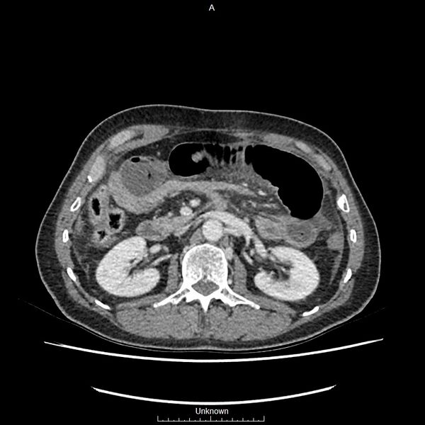 File:Closed loop bowel obstruction and ischemia (Radiopaedia 86959-103180 A 29).jpg
