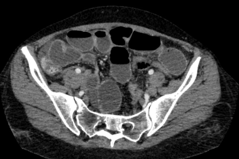 File:Closed loop small bowel obstruction (Radiopaedia 71211-81508 A 119).jpg