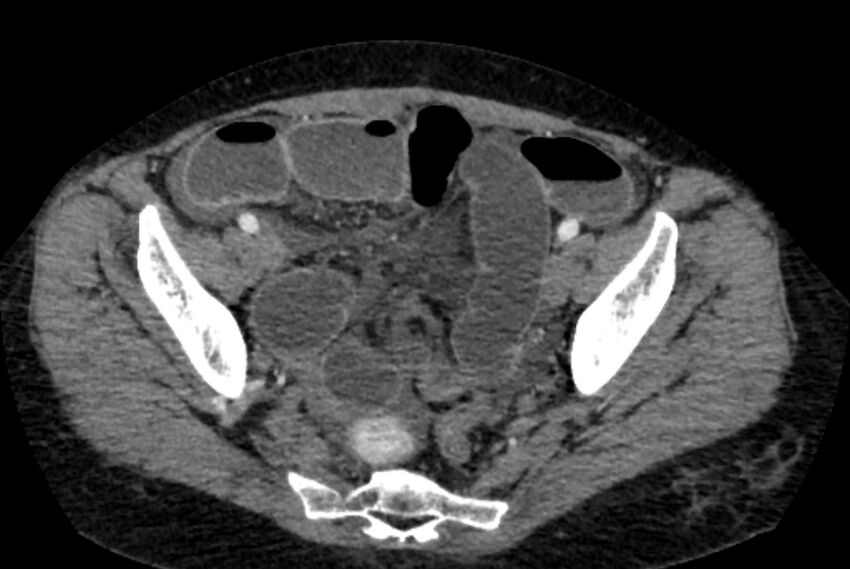 Closed loop small bowel obstruction (Radiopaedia 71211-81508 A 134).jpg