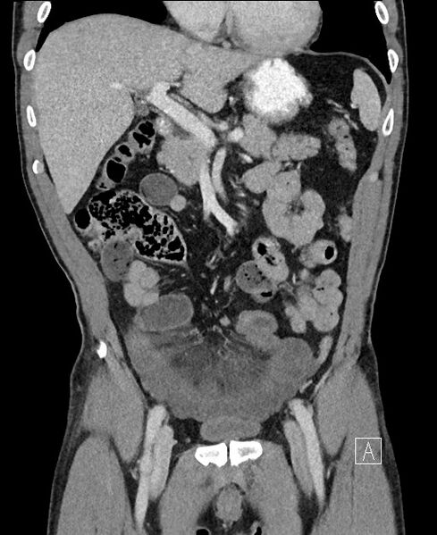 File:Closed loop small bowel obstruction - internal hernia (Radiopaedia 57806-64778 A 43).jpg