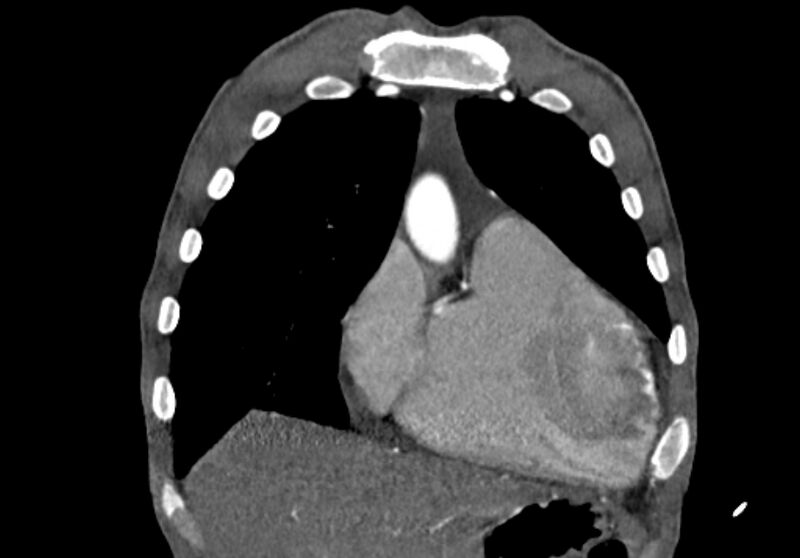 File:Coarctation of aorta with aortic valve stenosis (Radiopaedia 70463-80574 C 37).jpg